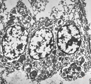  bone marrow … plasmocytoma (parafin-embedded sample)